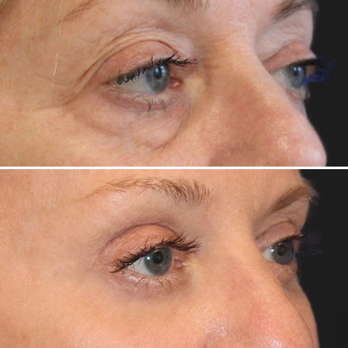 Peptide Collagen Hydrogel Eye Patches